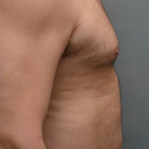 manhattan gynecomastia surgery before 4